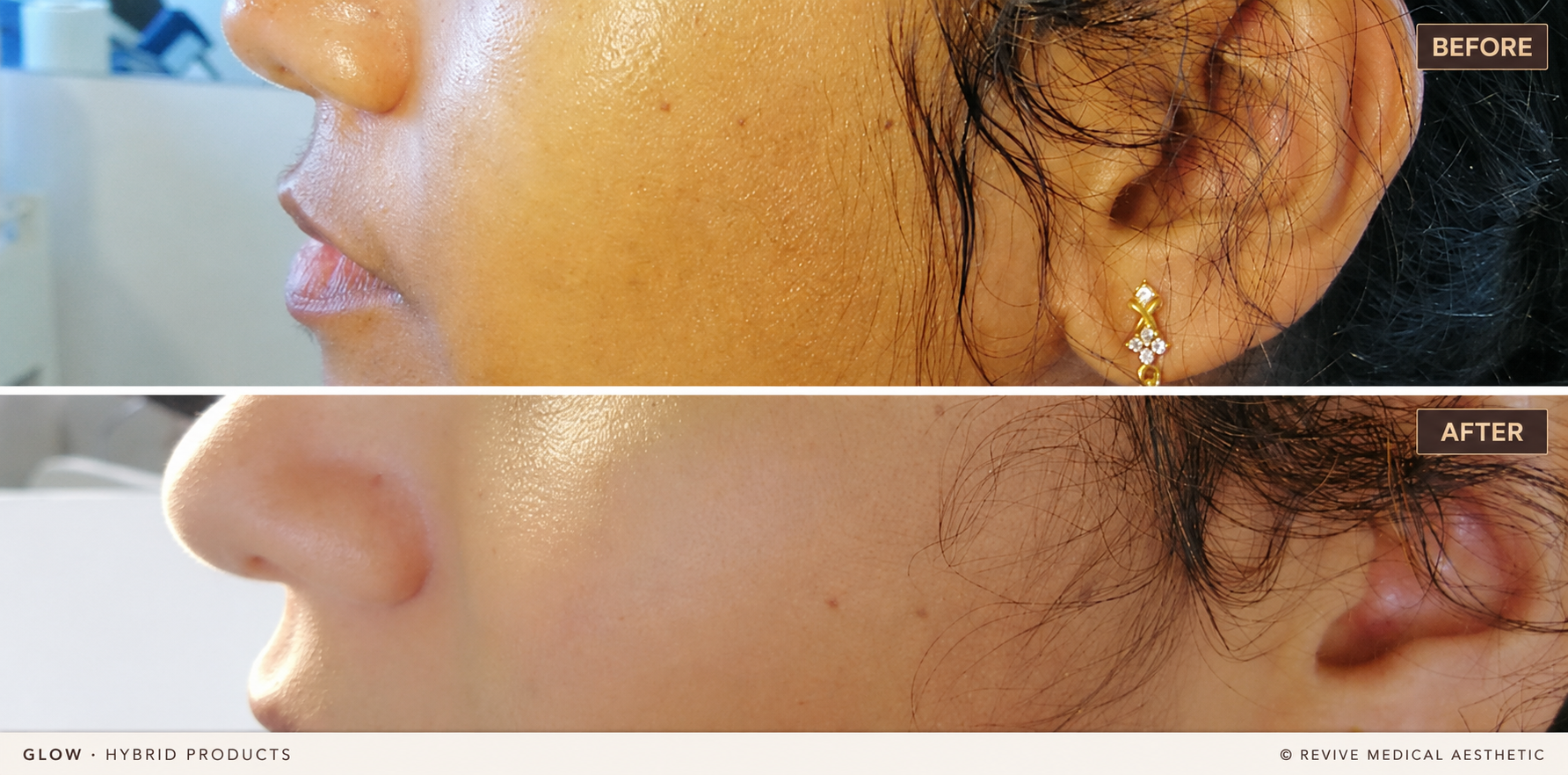 Before-and-after facial skin-quality clinical photographs
