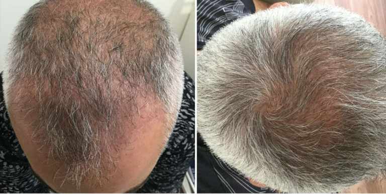 Hair-loss management before-and-after clinical photographs; the after photograph was taken six months after three treatments