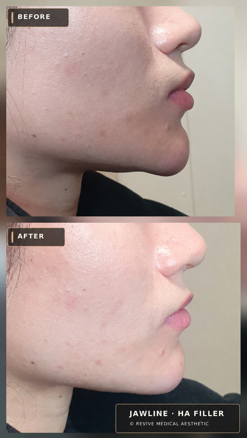 Before-and-after jawline clinical photographs